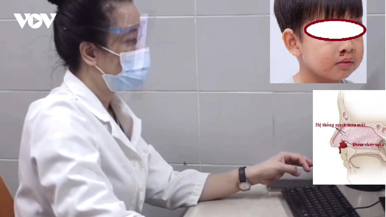 Chảy máu cam mùa đông, có nên lo lắng hay không?