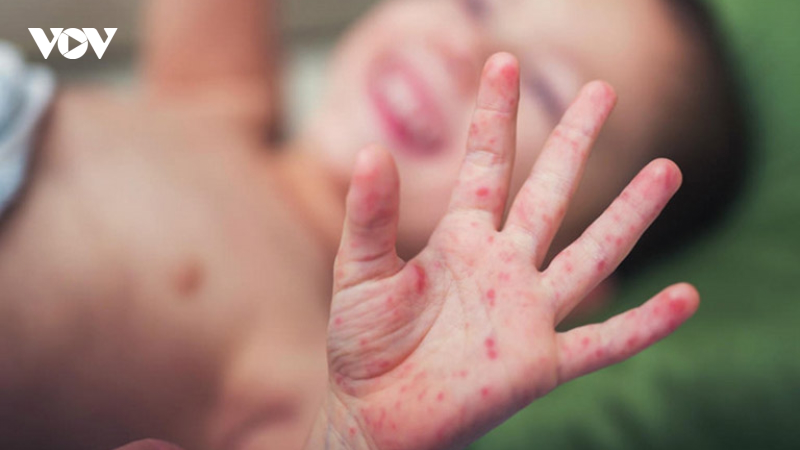 Không chủ quan khi trẻ bị viêm da cơ địa những ngày trời nồm