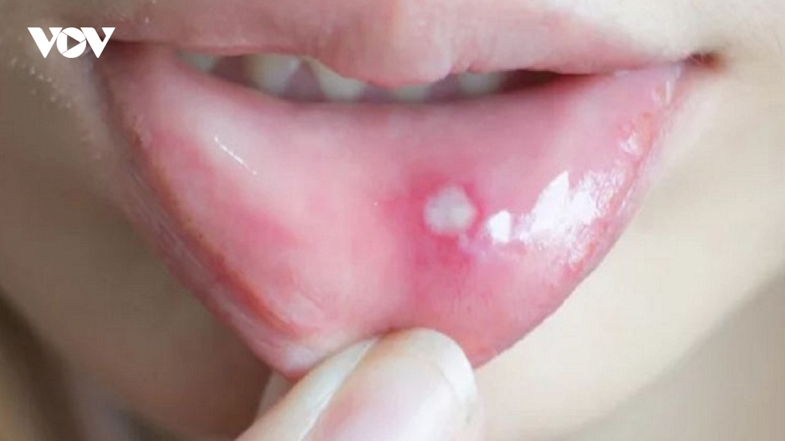 Phải làm gì khi loét miệng không biến mất?