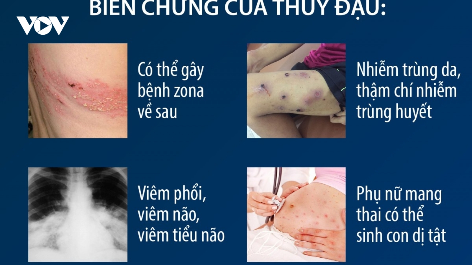Bệnh thủy đậu bùng phát ở Hà Nội: Chuyên gia khuyến cáo cách phòng bệnh