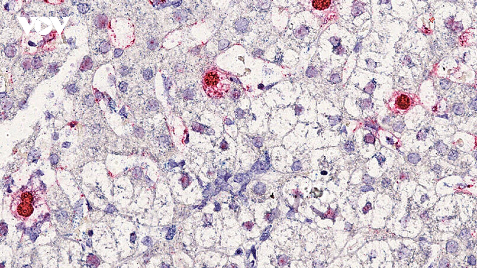 Phát hiện virus mới gây bệnh viêm gan ở người