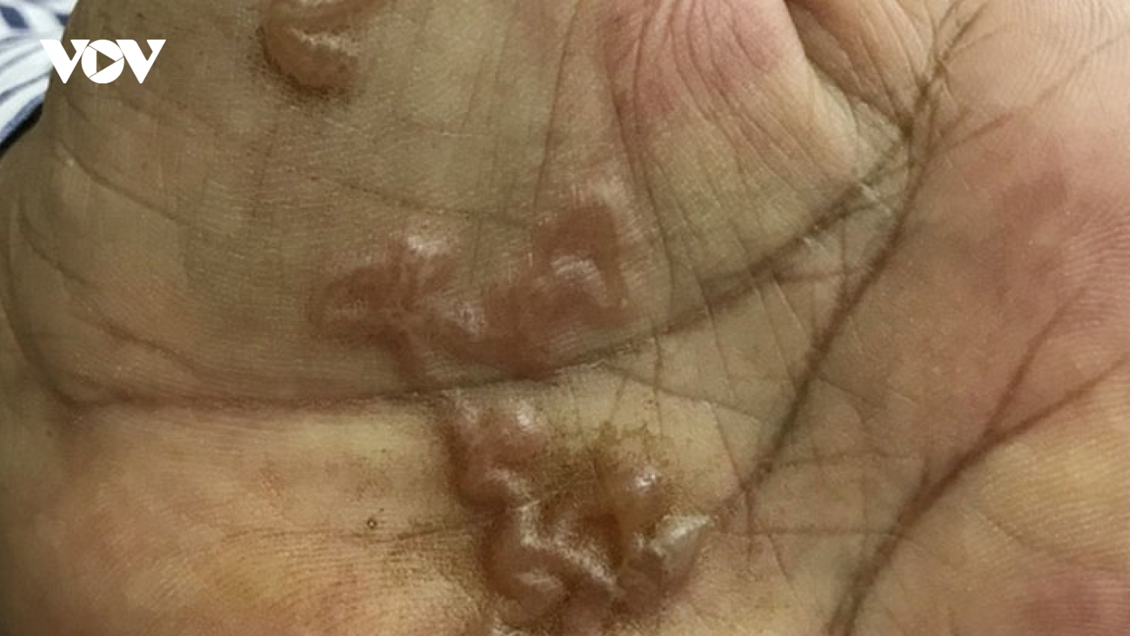 Trẻ chán ăn, bị xanh xao, gầy ốm... có lý do nhiễm giun?
