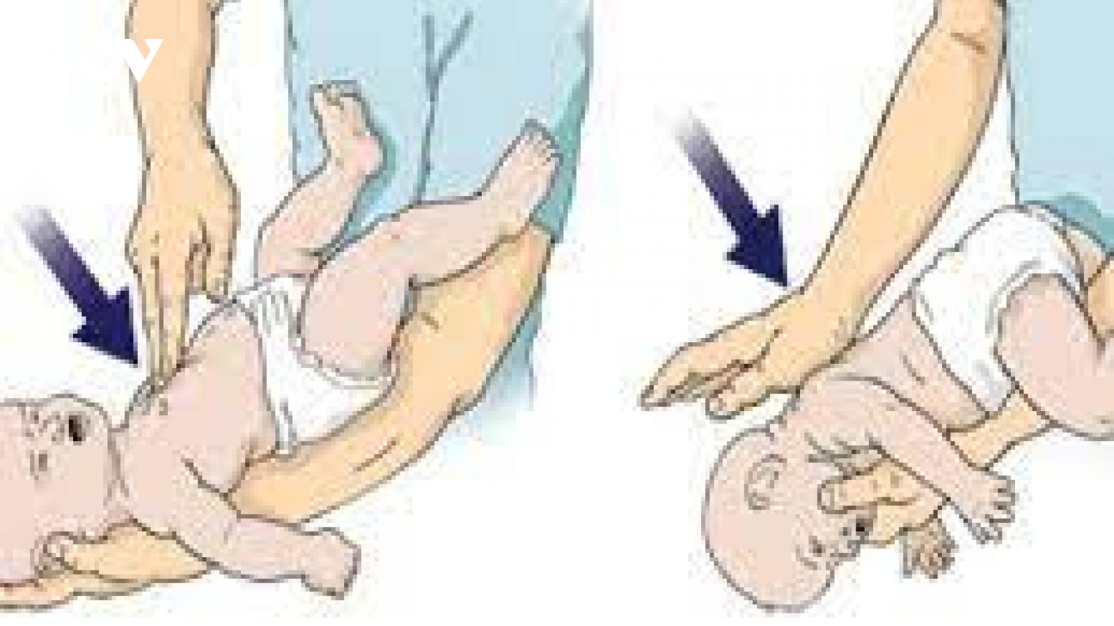 Cách sơ cứu trẻ sặc sữa tránh trường hợp tử vong đáng tiếc