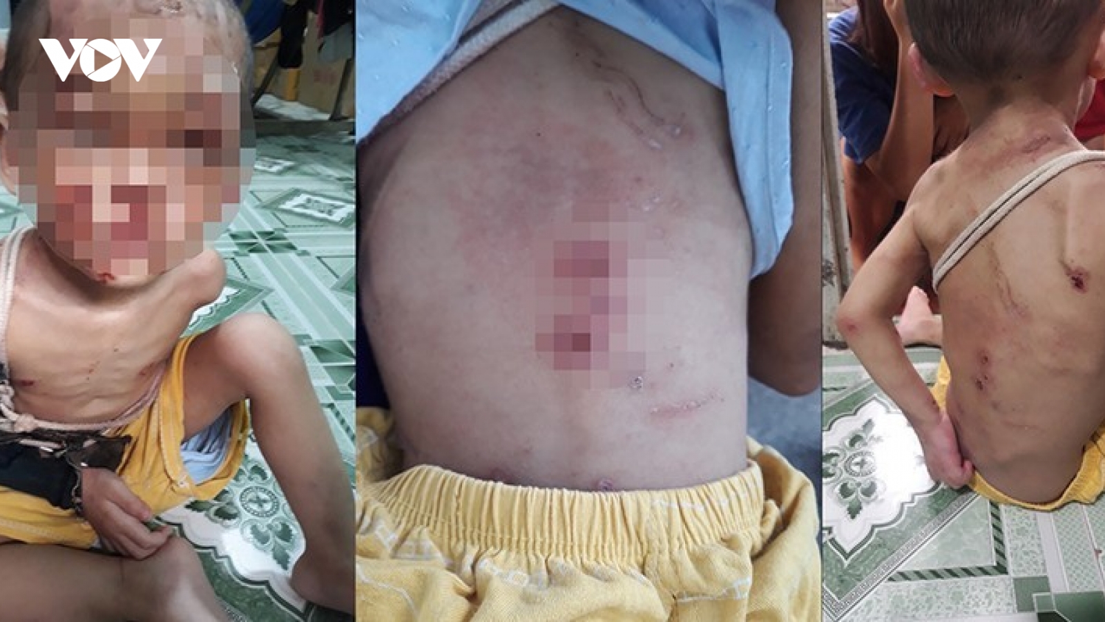 Bé trai nghi bị bạo hành ở Hóc Môn vẫn đang phải hồi sức tích cực