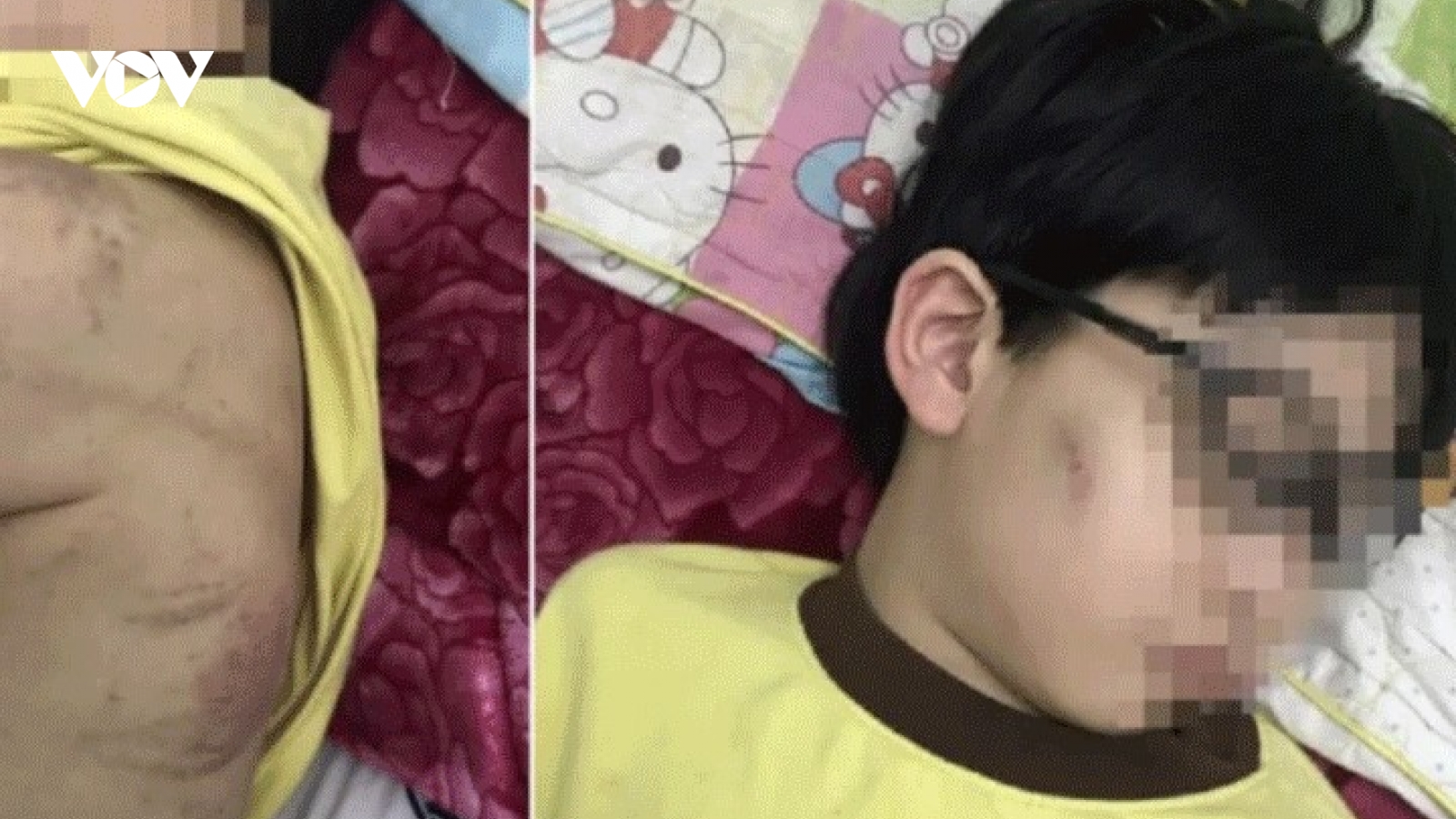 Chính quyền bác thông tin bé trai bị mẹ bạo hành phải nhập viện ở Quảng Ninh
