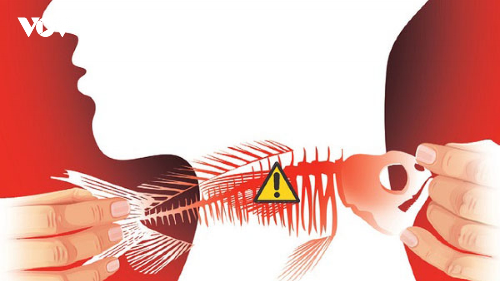 Xương cá đâm thủng amidan, bé trai phải nhập viện cấp cứu
