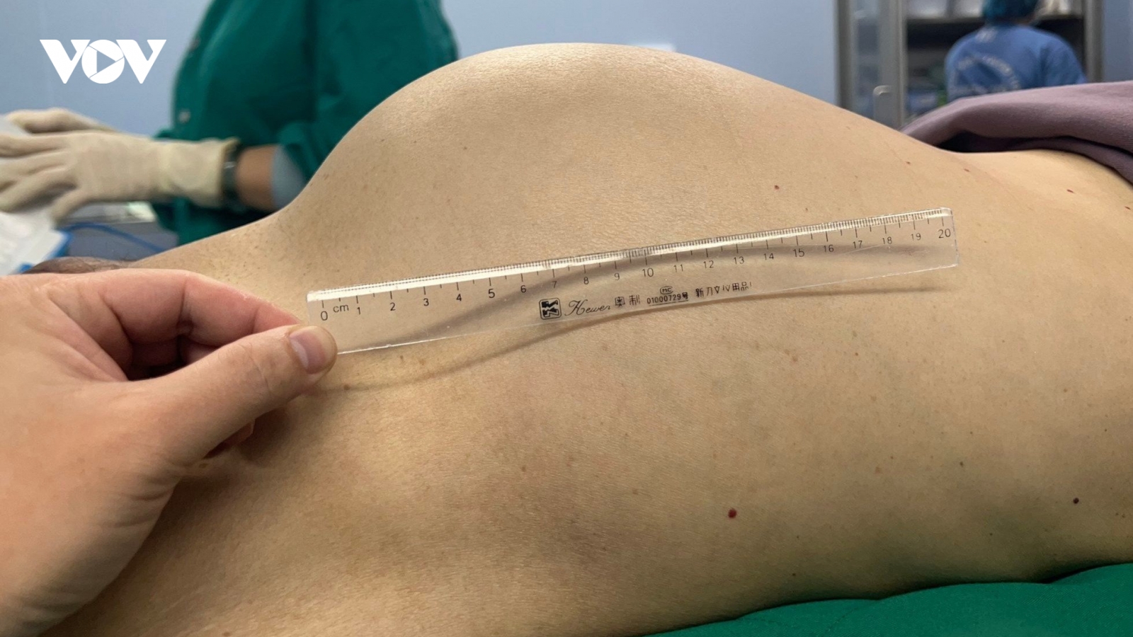 Loại bỏ khối u khổng lồ chèn ép thận của nam bệnh nhân