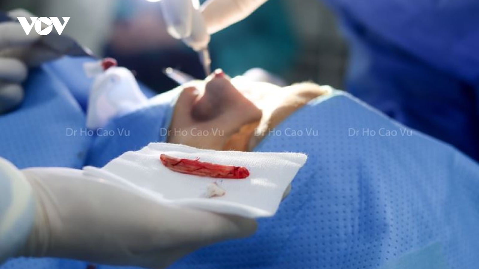 Nâng mũi cấu trúc biến chứng phổ biến cần biết