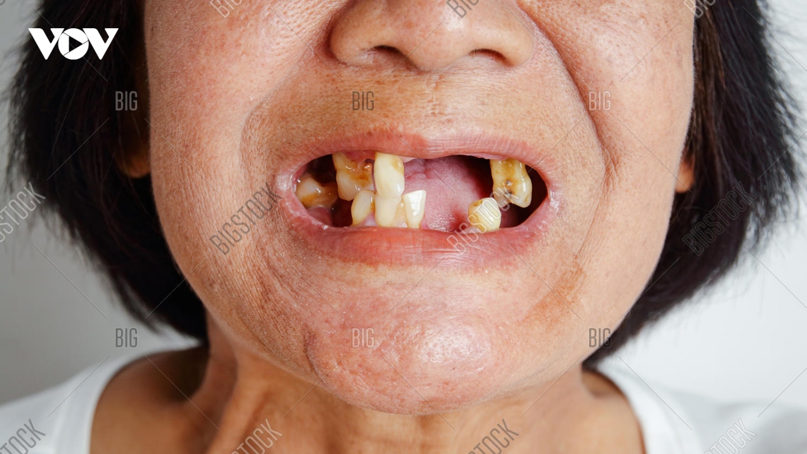 Tỷ lệ rụng răng trong người dân vùng Tây Thái Bình Dương là cao nhất