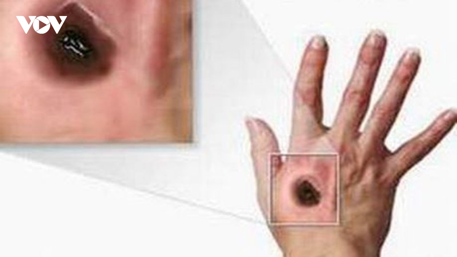 Những điều cần biết về bệnh than