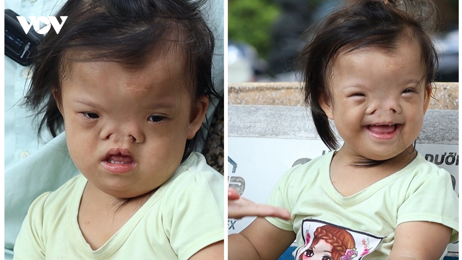 Bé 4 tuổi bị khuyết tật sọ mặt bẩm sinh cần sự giúp đỡ từ cộng đồng