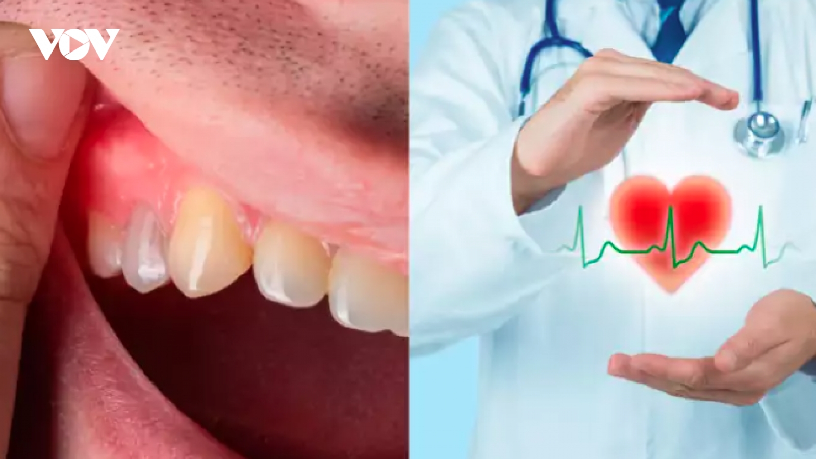 Bệnh nướu răng không được điều trị làm tăng nguy cơ mắc bệnh tim