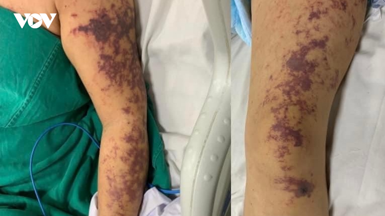 Phải nhập viện thở oxy liều cao sau khi ăn lòng lợn