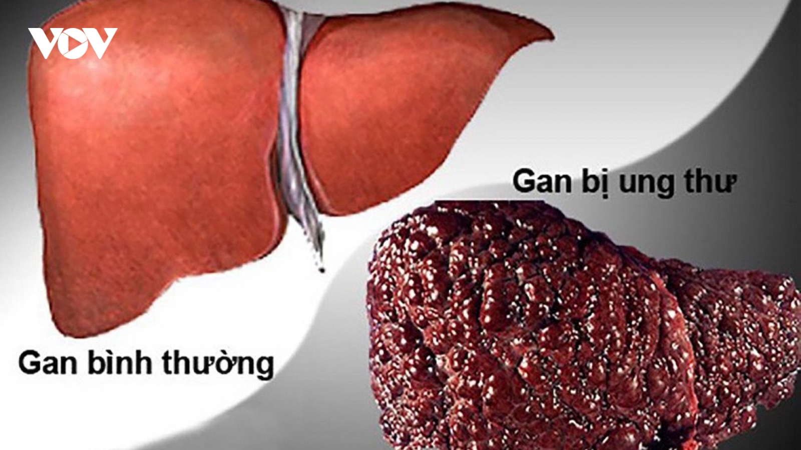 Ung thư gan có số ca tử vong dẫn đầu
