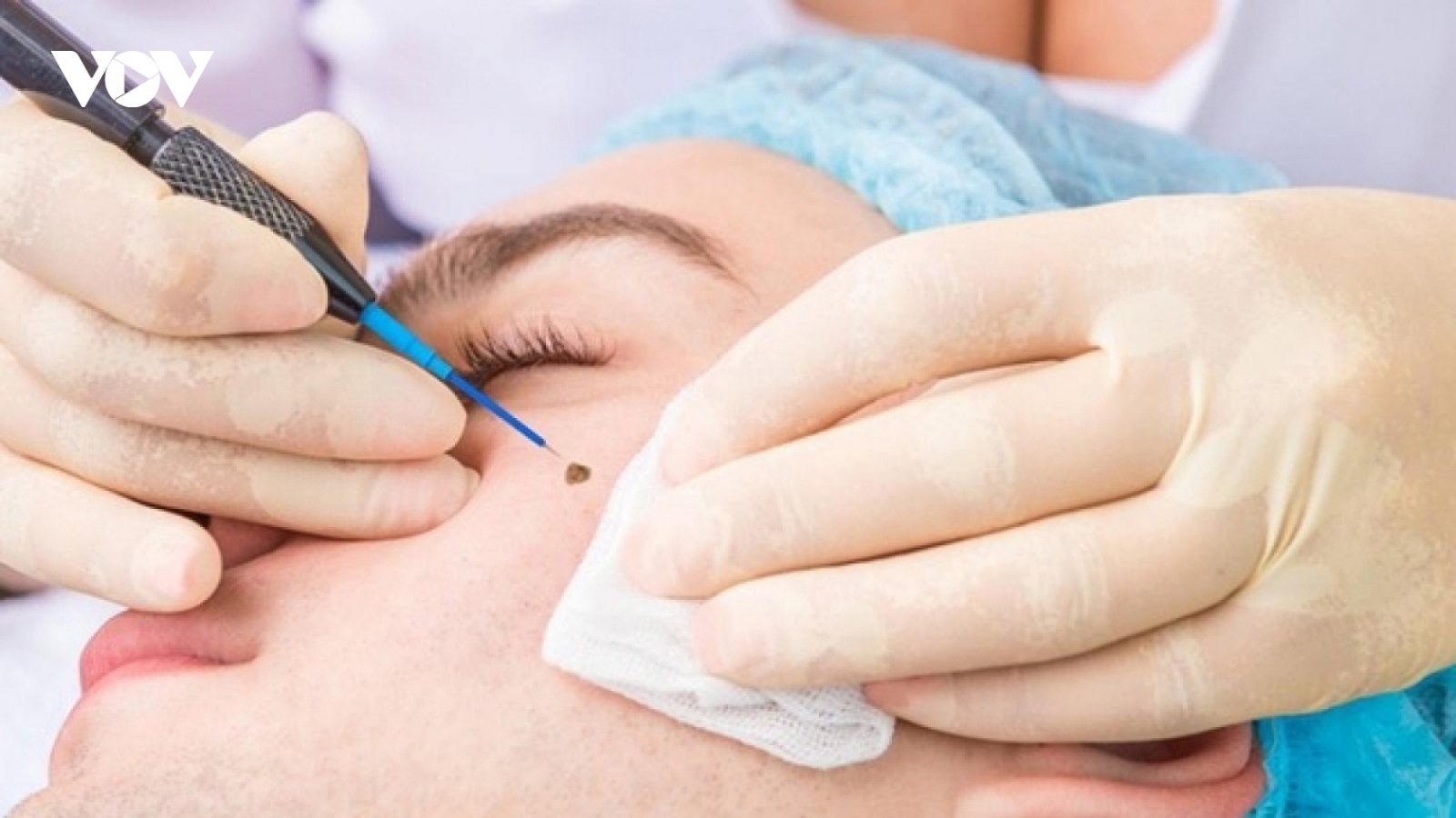 Xóa nốt ruồi bằng phương pháp laser có sợ nguy cơ bị ung thư?