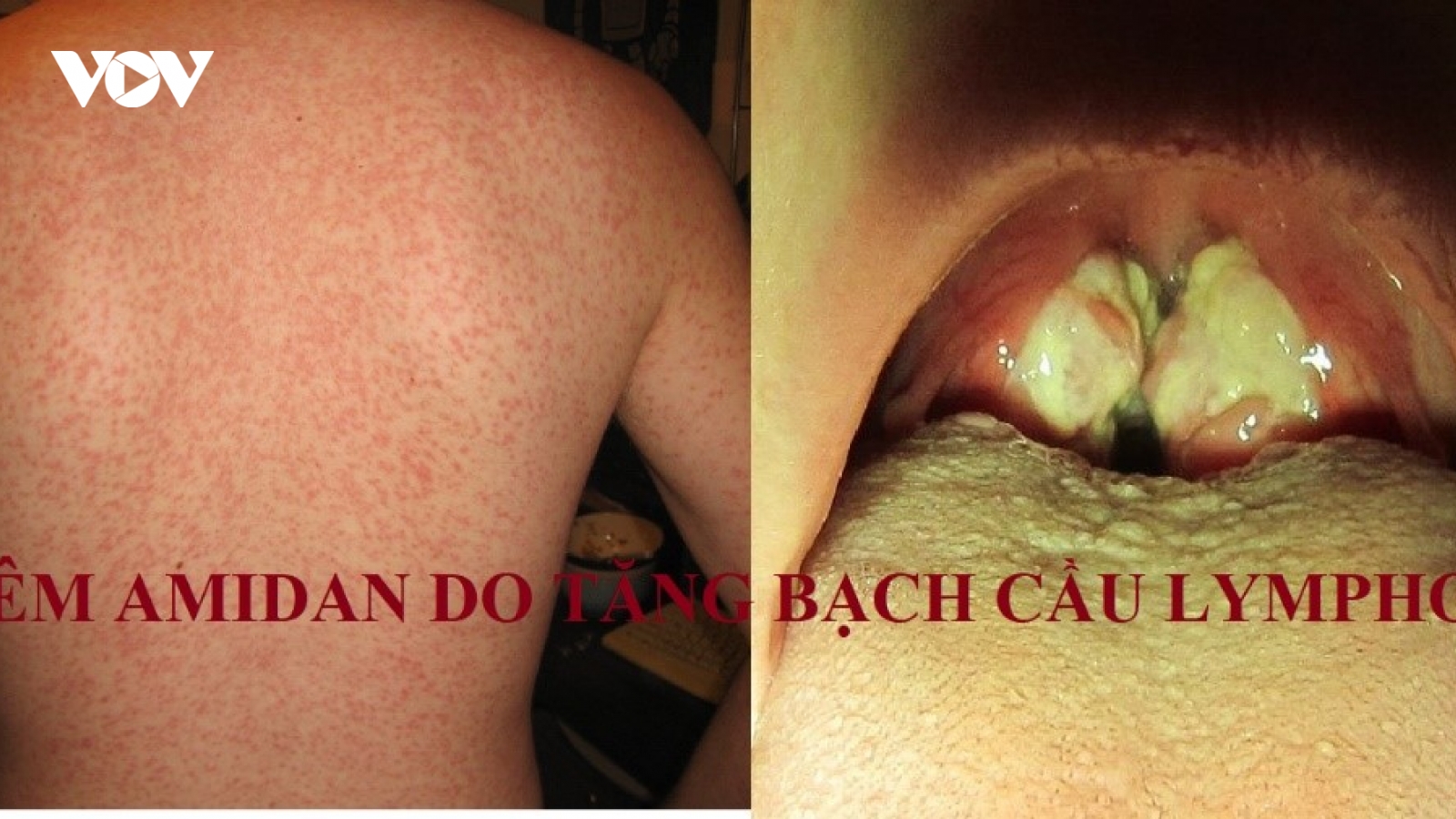 Viêm Amidan do tăng bạch cầu đơn nhân - một thể viêm amidan đặc biệt
