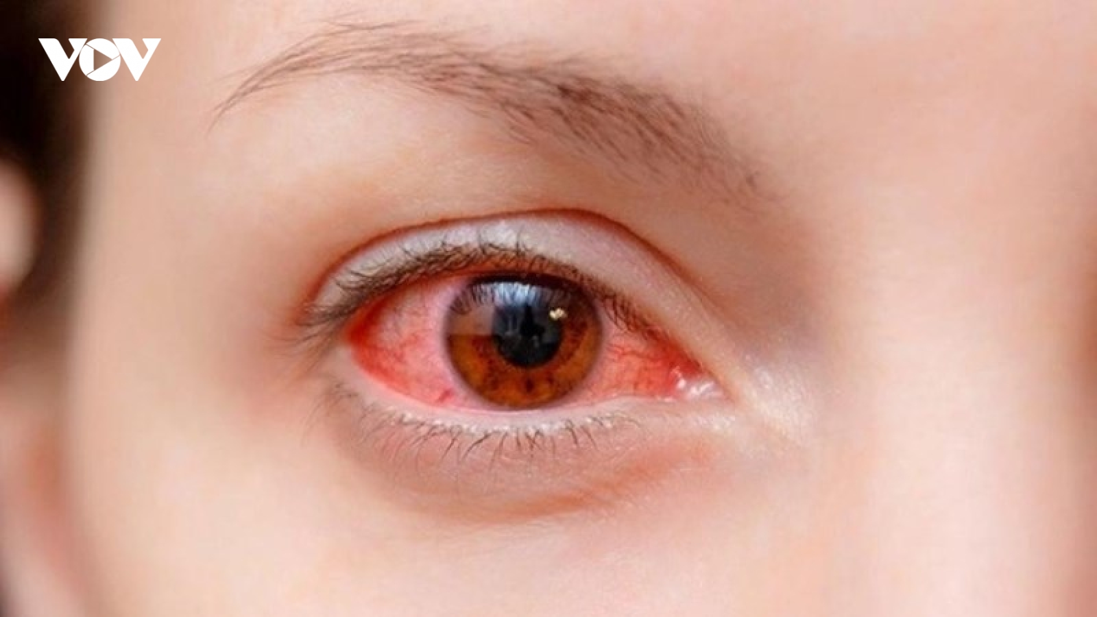 Đau mắt đỏ và một số vấn đề cần biết