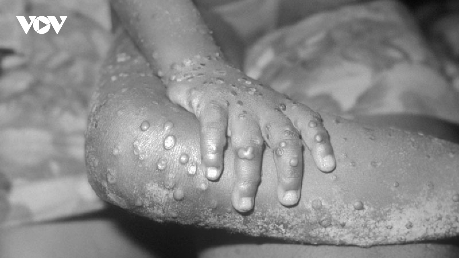 Ca nghi mắc đậu mùa khỉ ở Đà Nẵng đã có kết quả xét nghiệm âm tính