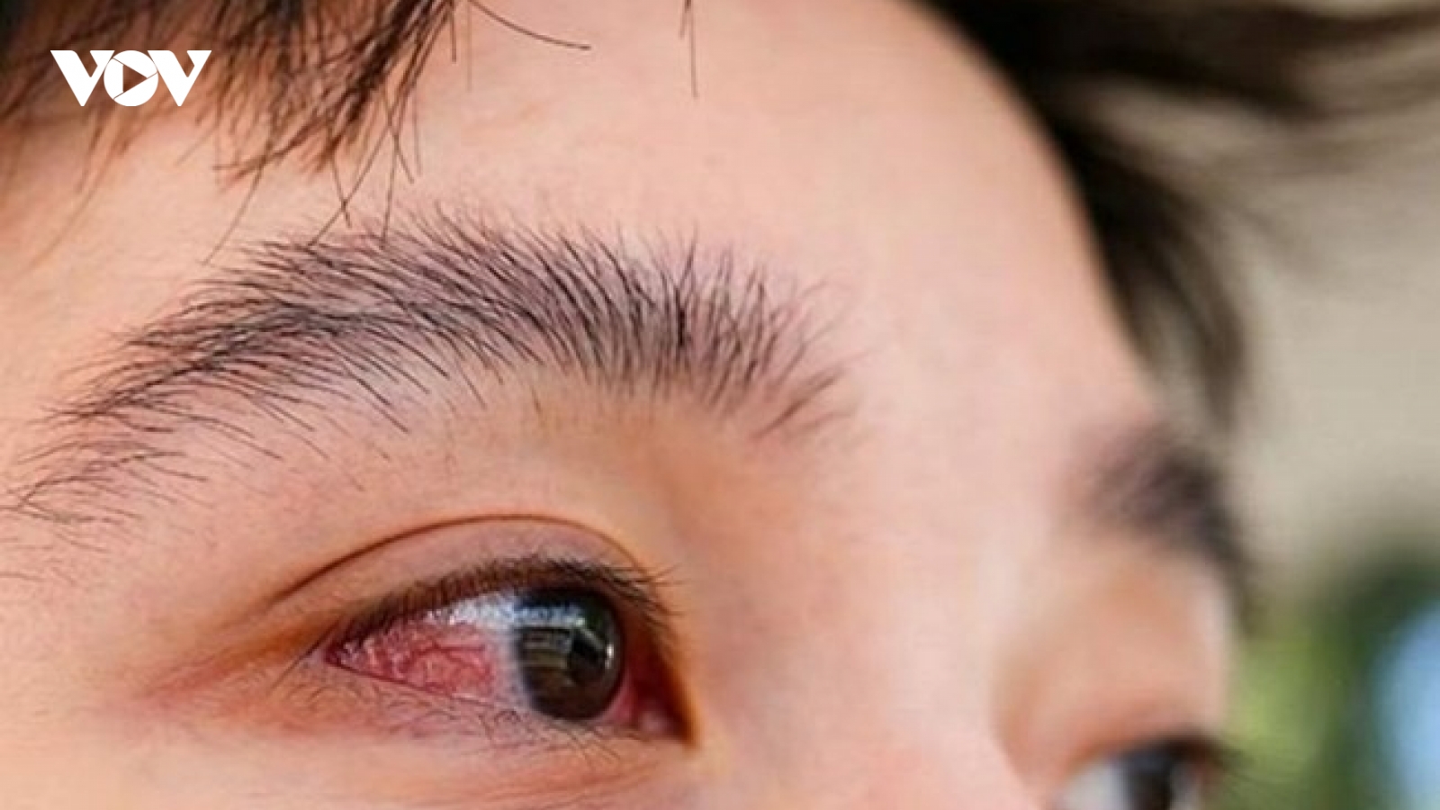 Những lưu ý trong điều trị và sử dụng thuốc đau mắt đỏ