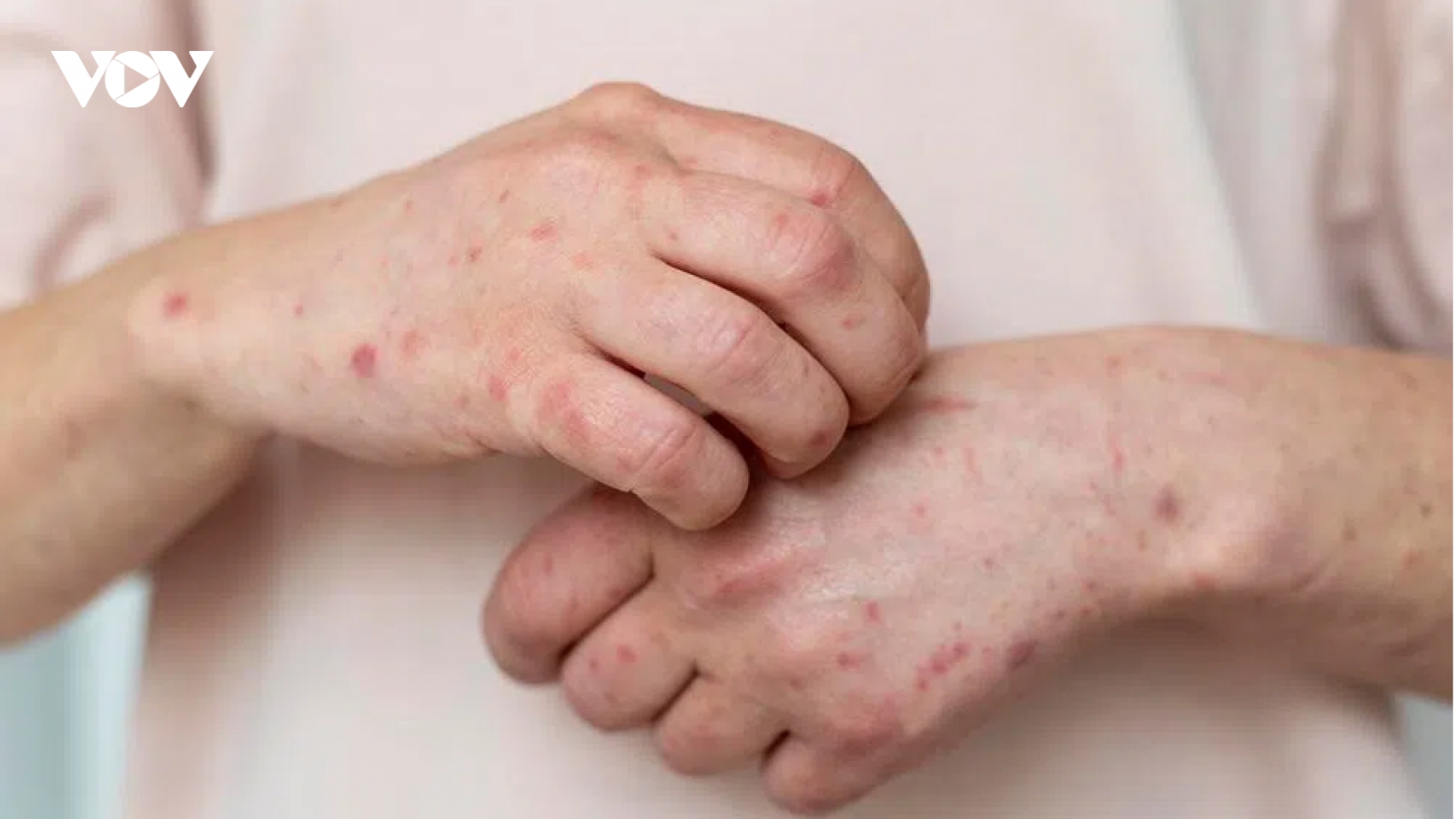 "Đậu mùa khỉ xâm nhập vào Việt Nam là khó tránh khỏi"