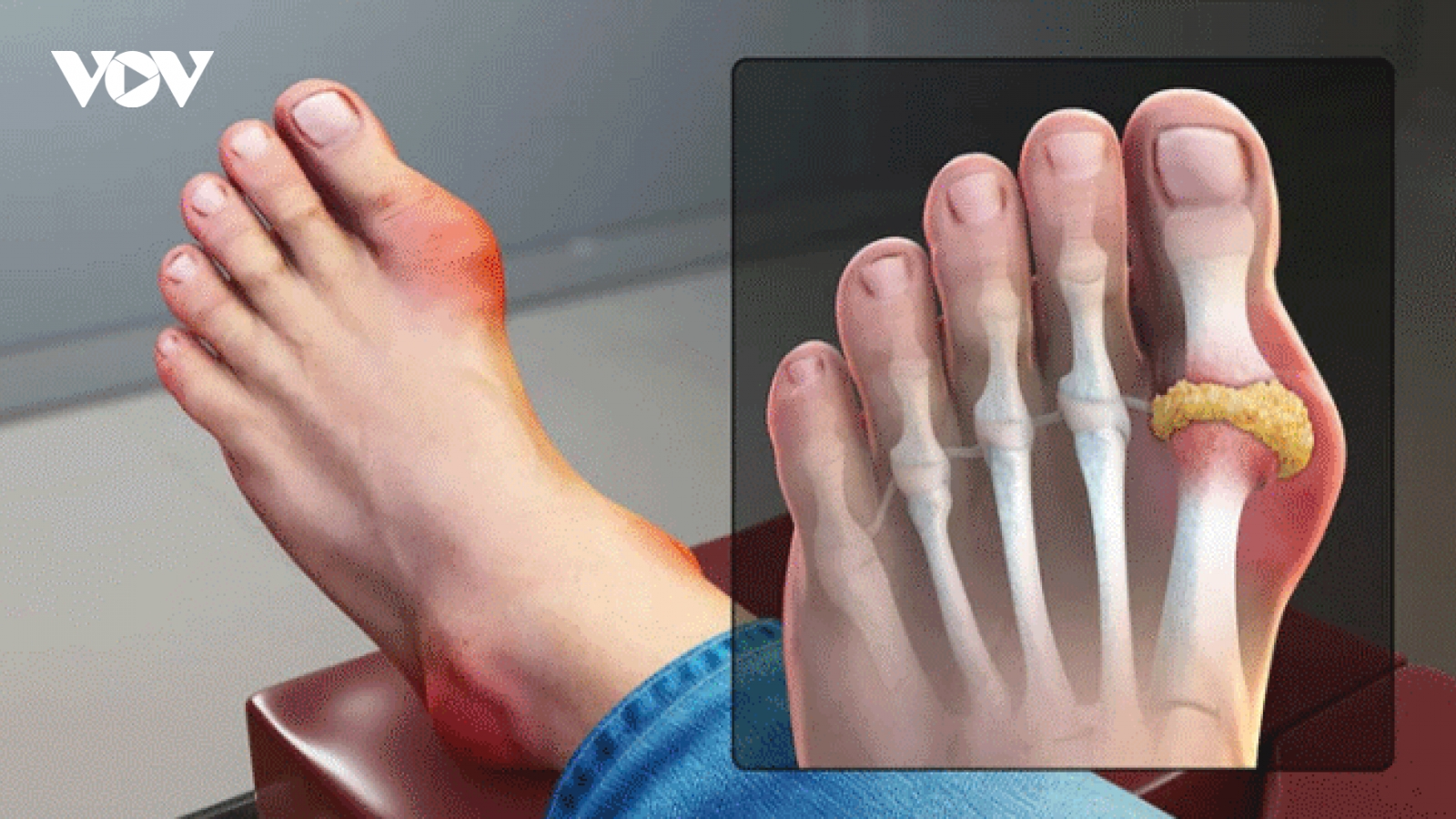 Bệnh gout có xu hướng trẻ hóa, bác sĩ chỉ cách phòng ngừa