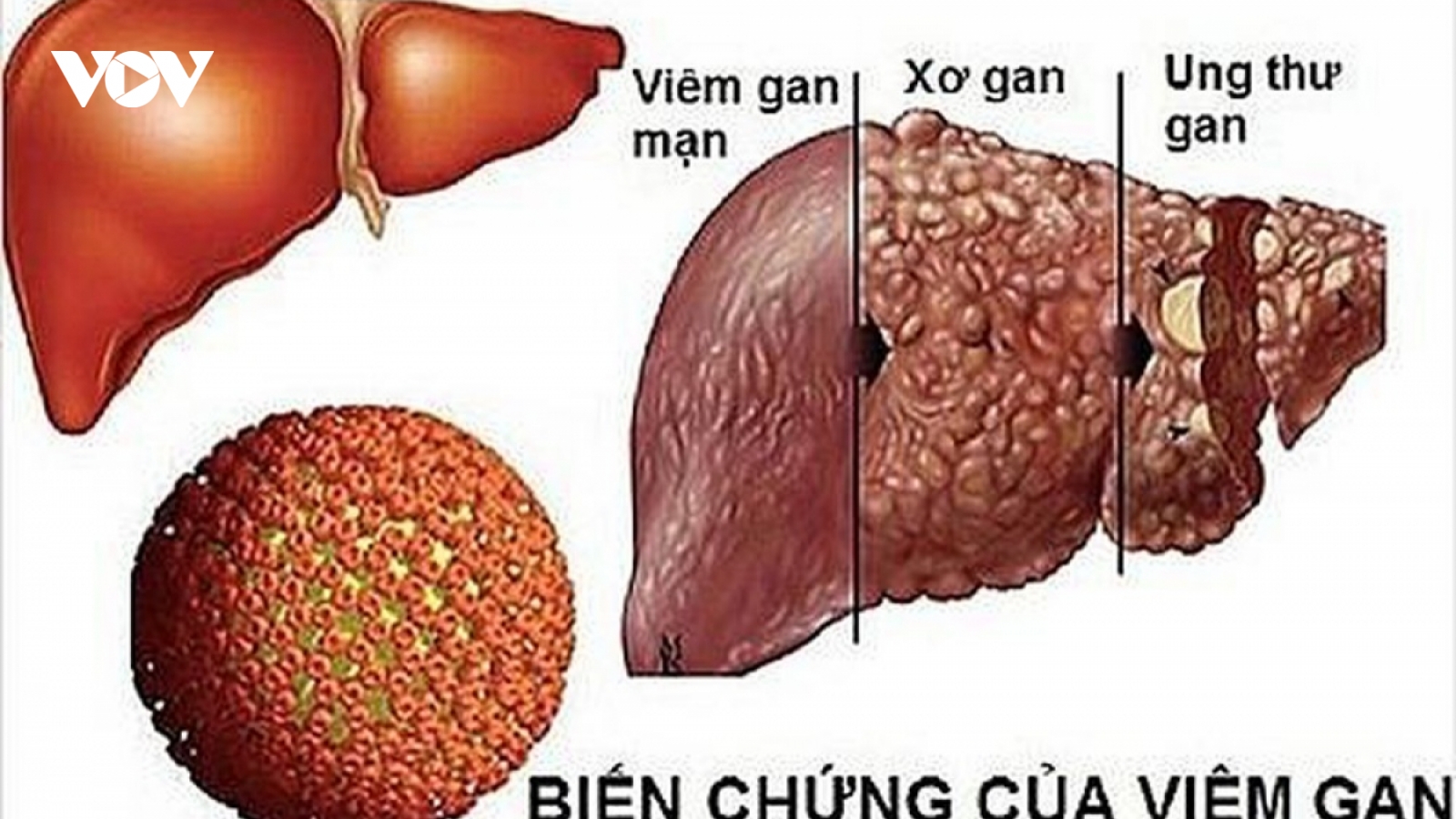 Tầm soát, phát hiện sớm ung thư gan bằng cách nào?