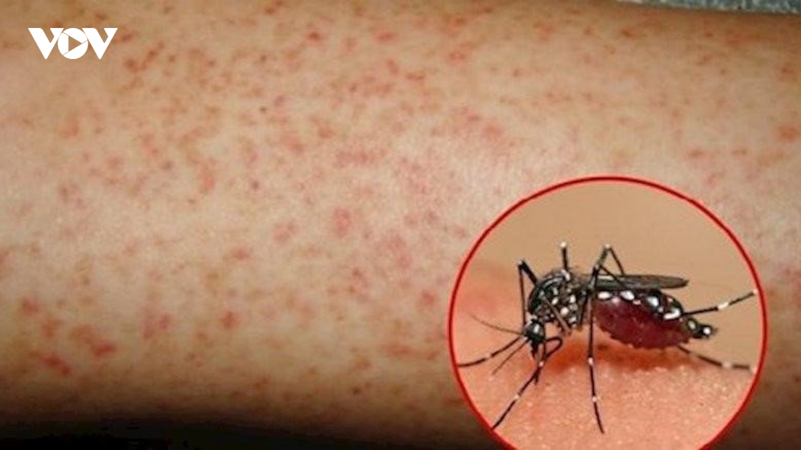 Dịch sốt xuất huyết vẫn bùng phát mạnh, bác sĩ cảnh báo