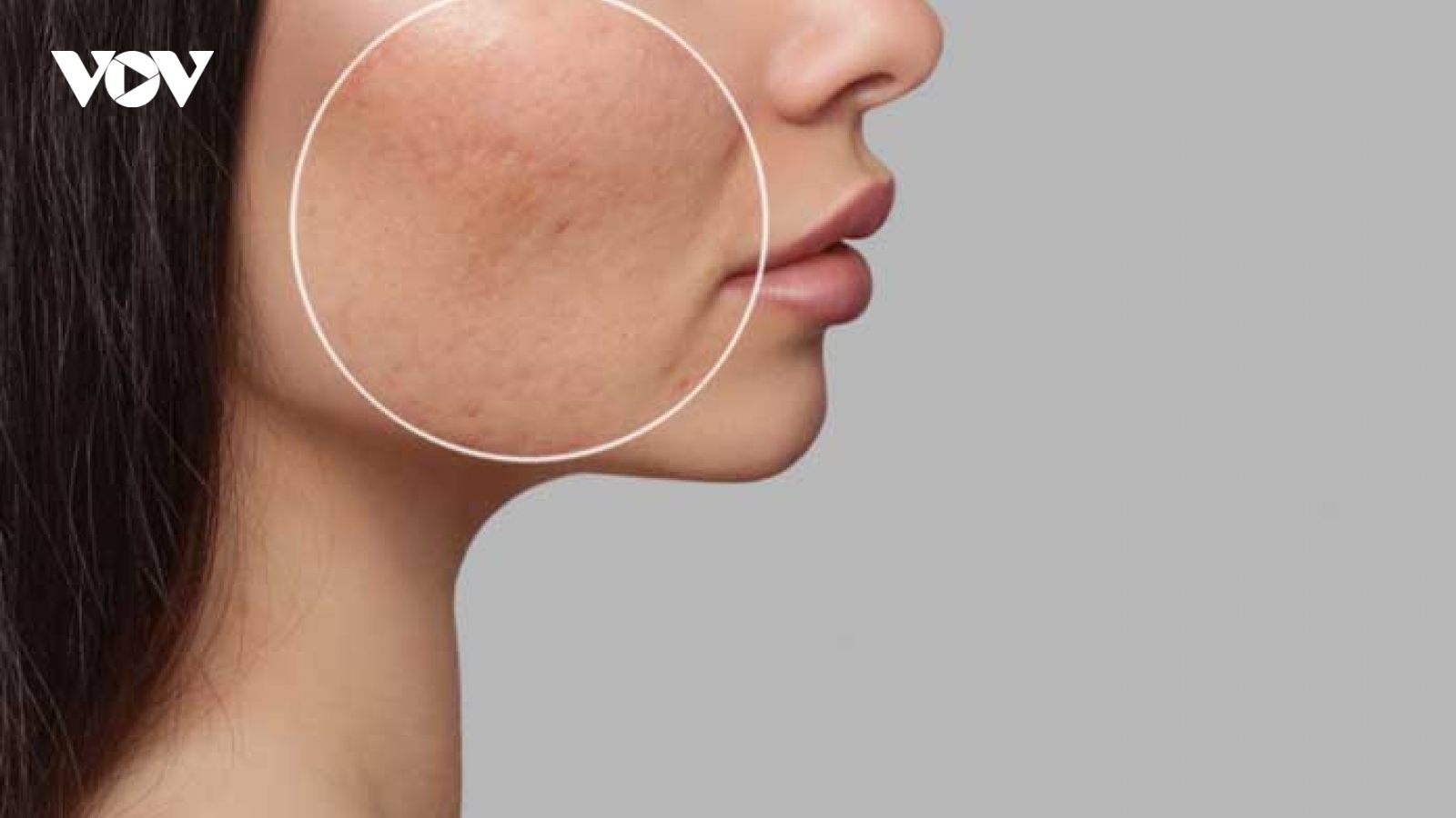 Nguyên nhân gây bít lỗ chân lông