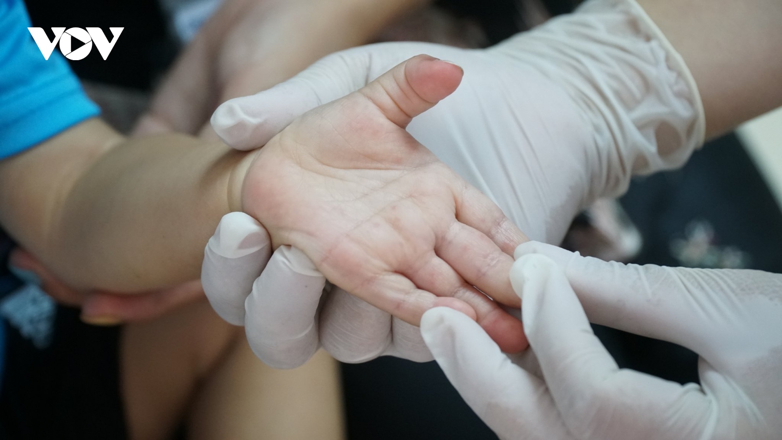 Đắk Lắk thêm một bệnh nhi 2 tuổi tử vong vì bệnh tay chân miệng