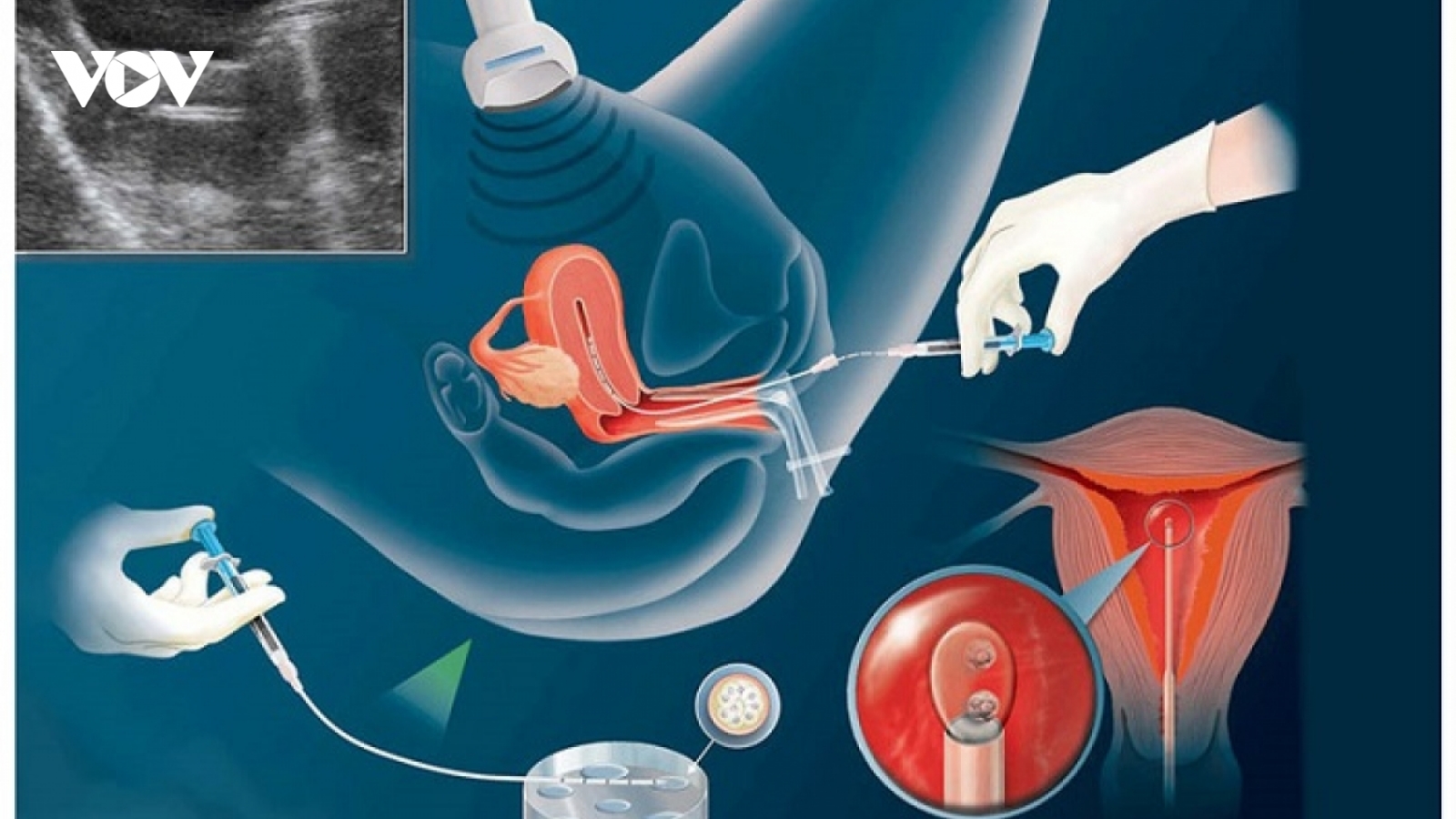 Đề xuất bảo hiểm y tế hỗ trợ chi phí điều trị vô sinh, hiếm muộn