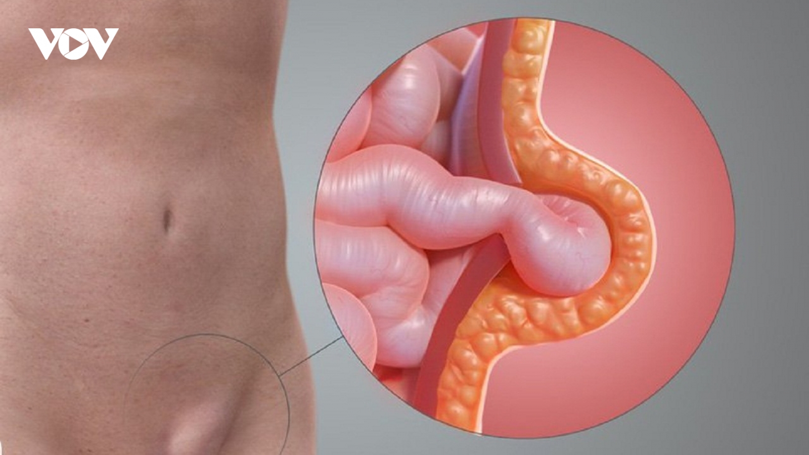 Tình trạng tinh hoàn không đều ở trẻ có ảnh hưởng đến khả năng sinh sản sau này?