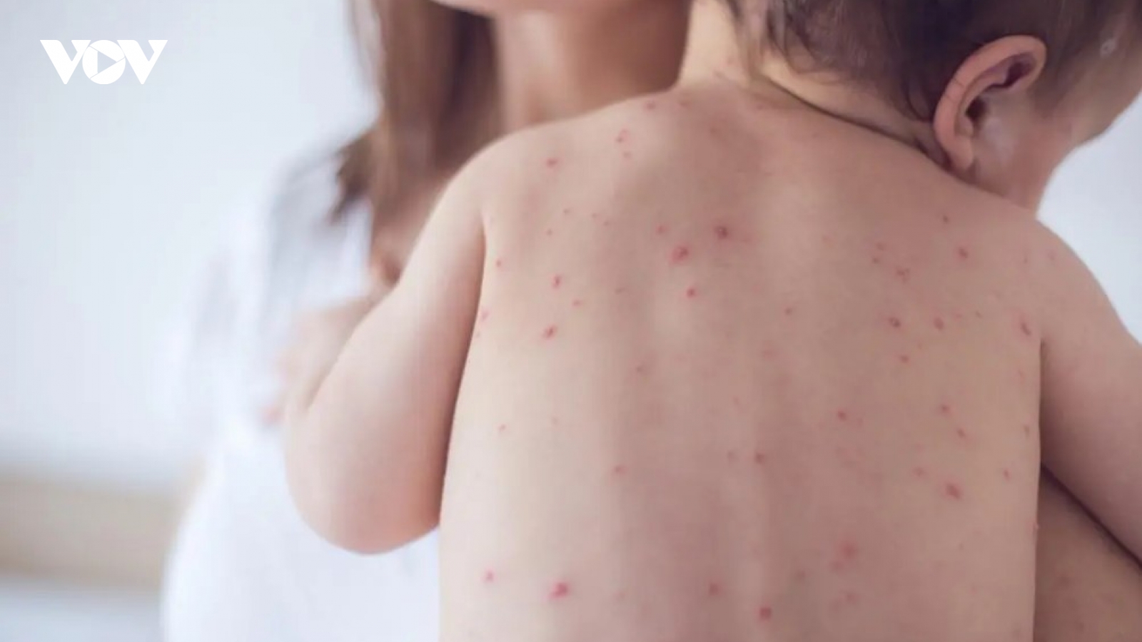 Hướng dẫn cách phòng và chăm sóc trẻ mắc bệnh sởi khi đến mùa