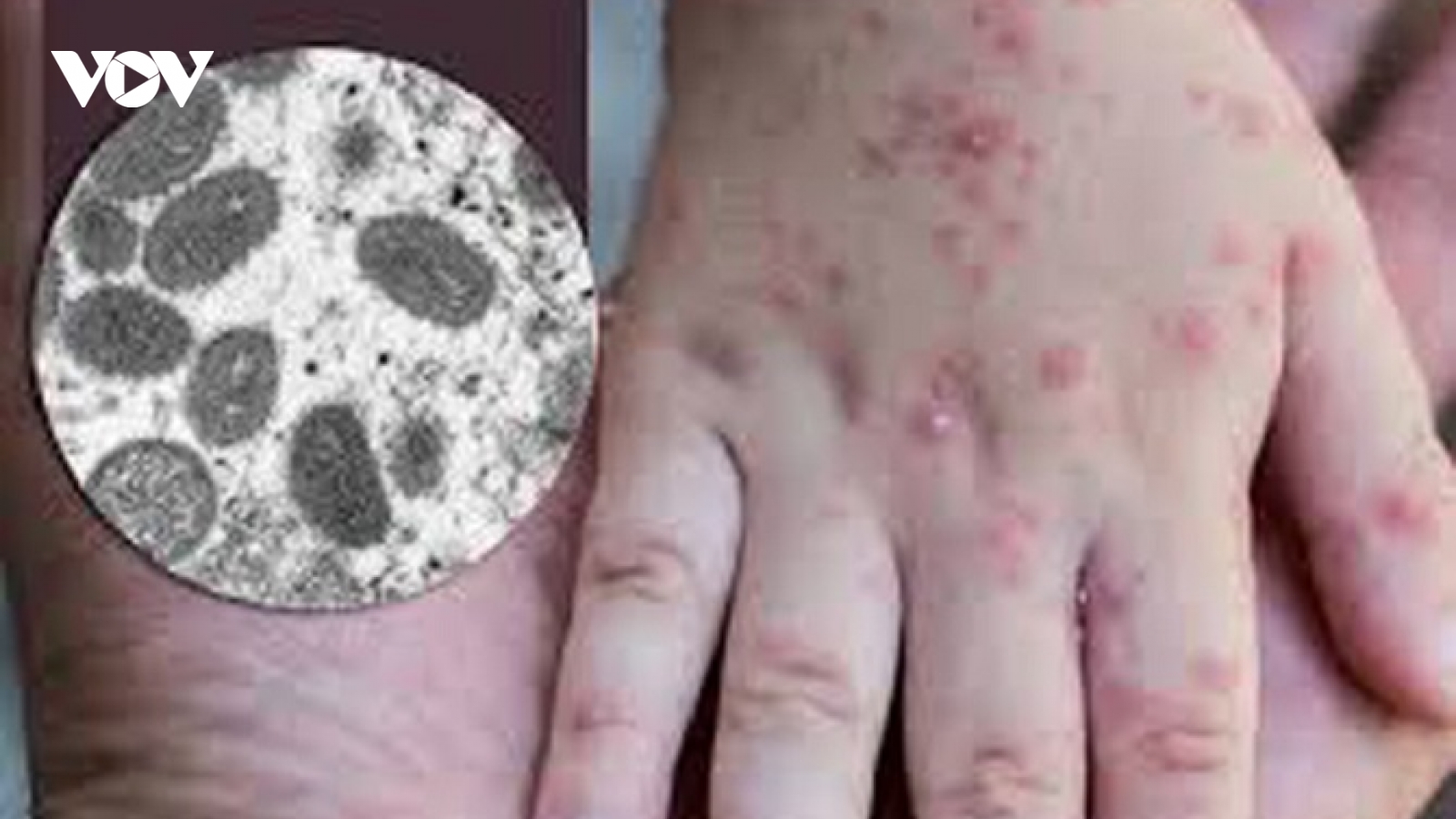 Cà Mau kết thúc ổ dịch đậu mùa khỉ