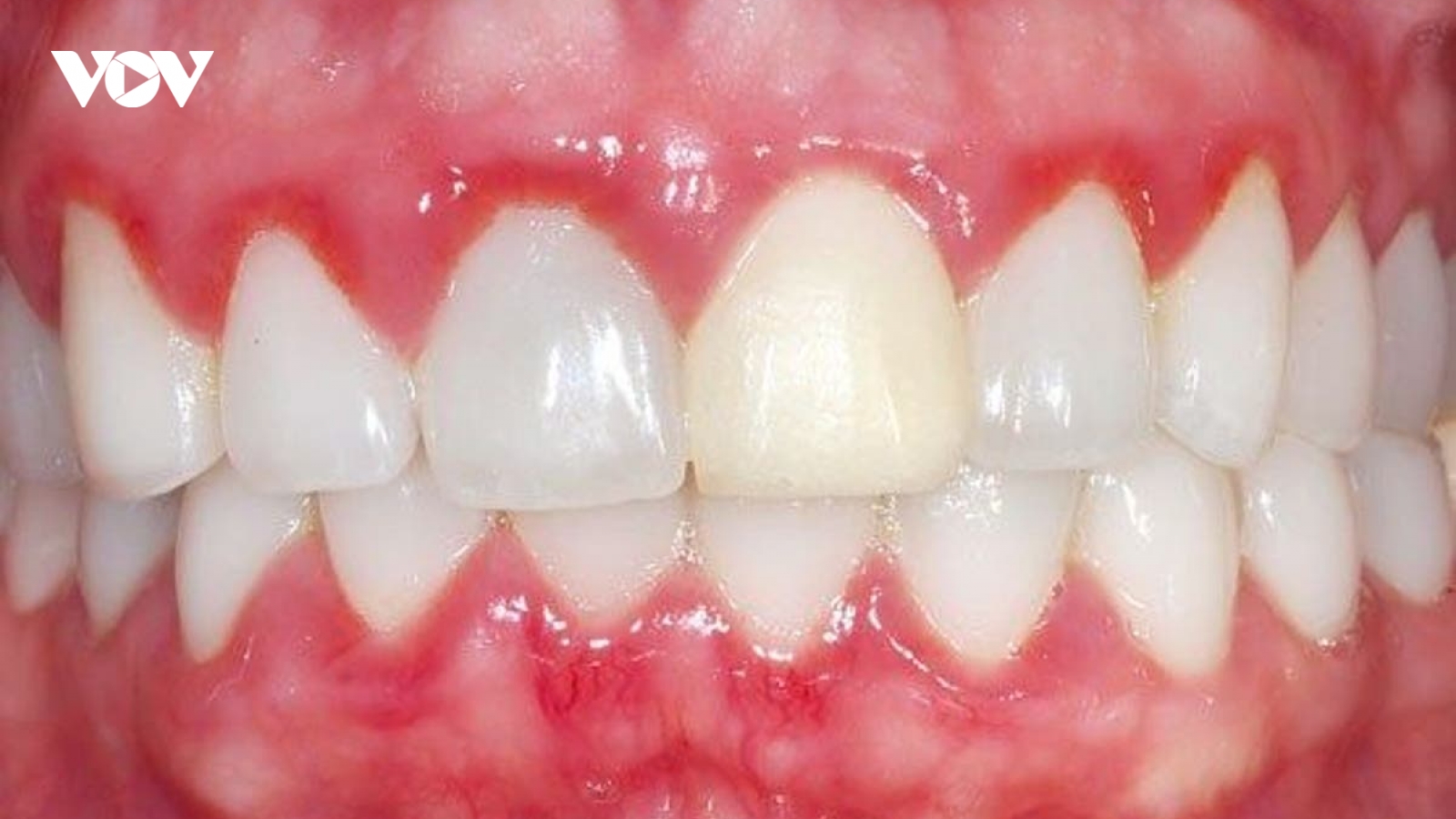 Viêm nướu, viêm nha chu - bệnh không thể xem nhẹ