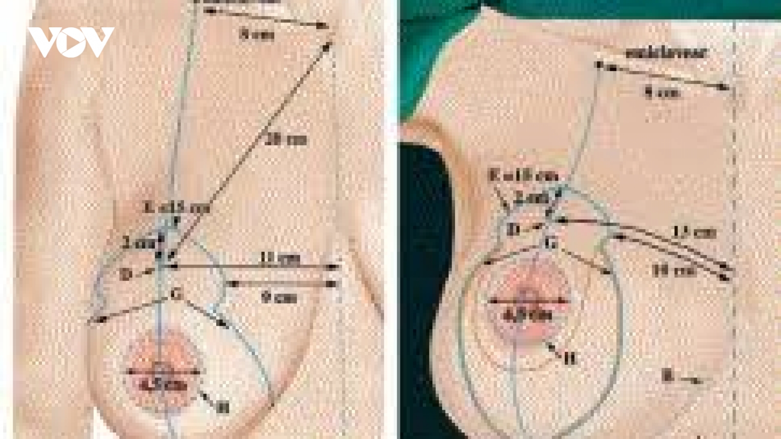 Nâng ngực một thời gian, bị vỡ túi ngực mà không hề hay biết