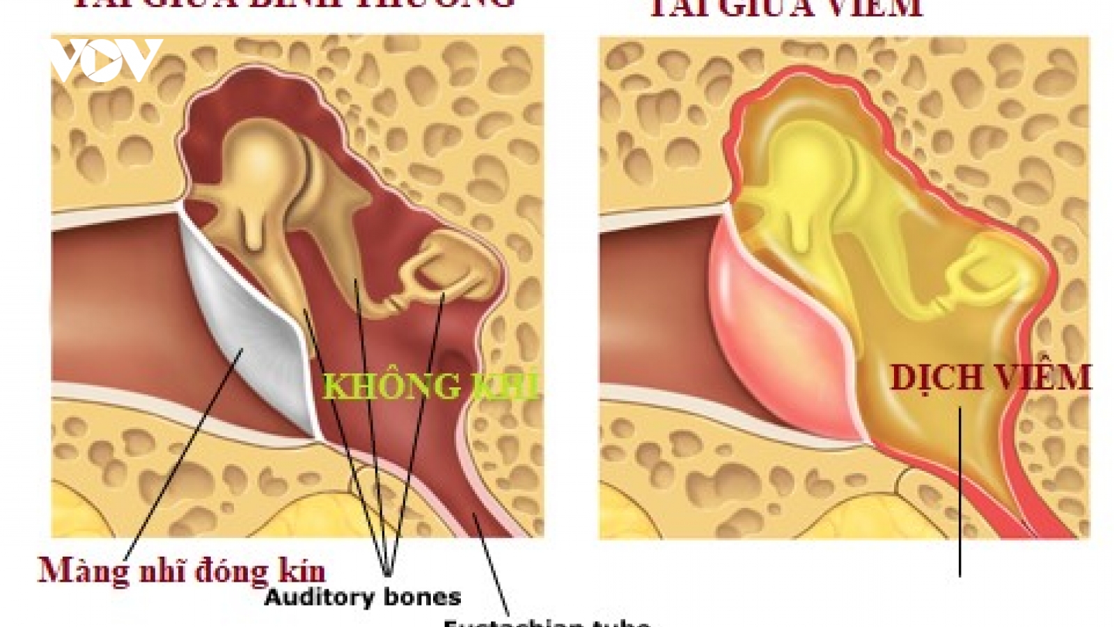 Vì sao thời gian điều trị viêm tai giữa thường kéo dài nhiều tuần?