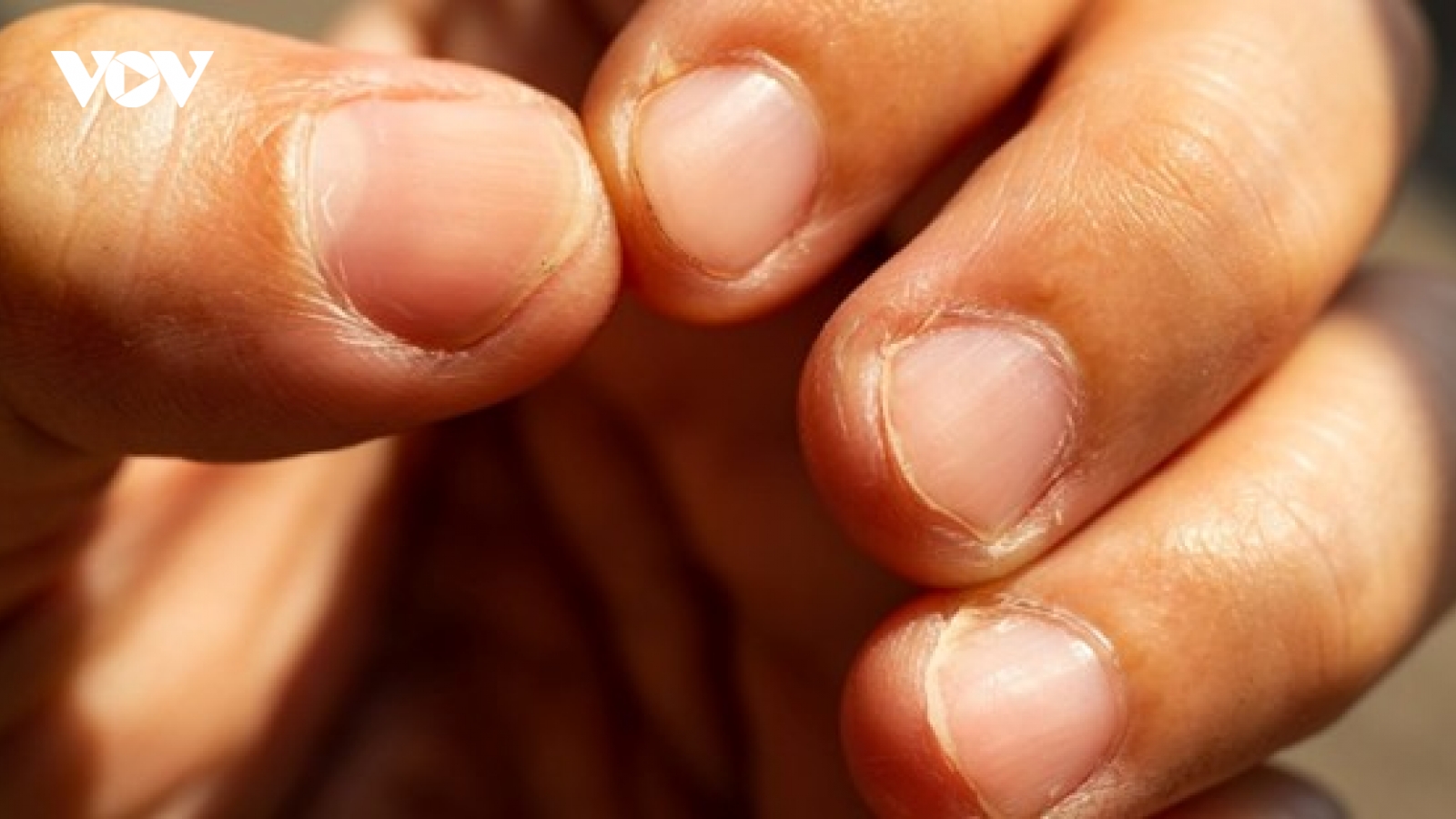 5 dấu hiệu bất thường trên móng tay tuyệt đối không coi nhẹ