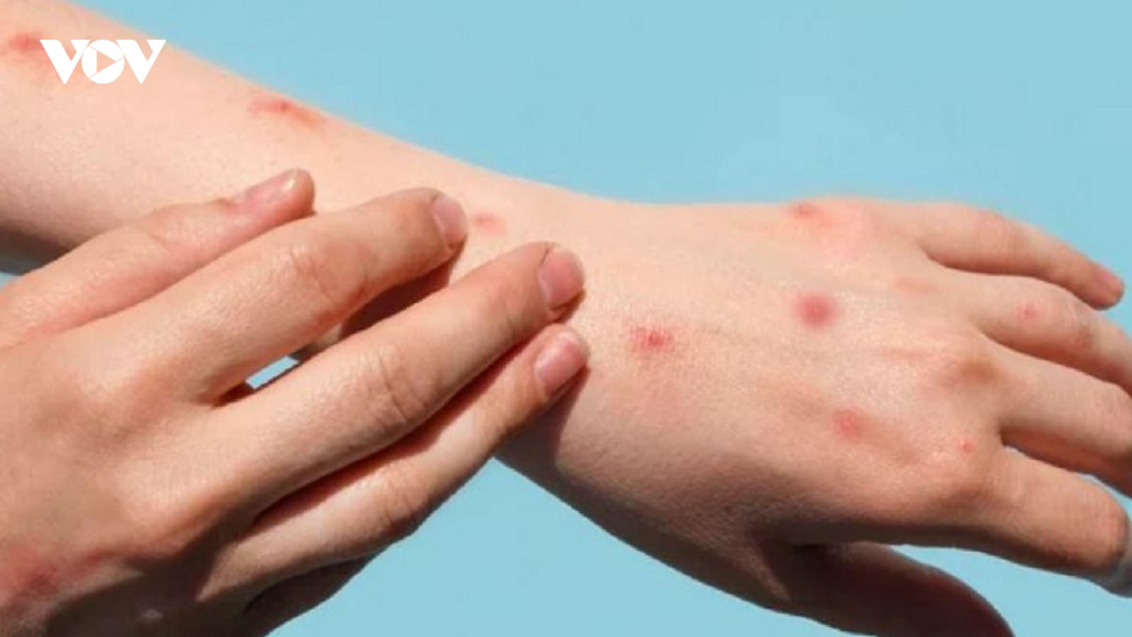 Campuchia cảnh giác trước nguy cơ bùng phát dịch đậu mùa khỉ