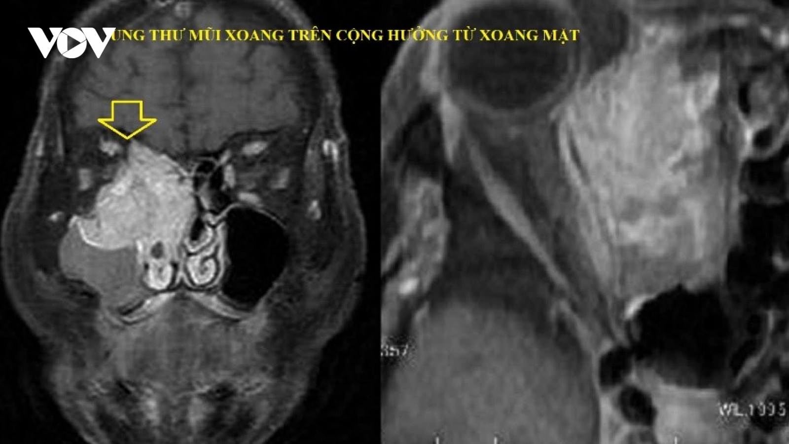 Ung thư mũi xoang được phát hiện nhờ biểu hiện đau vùng má