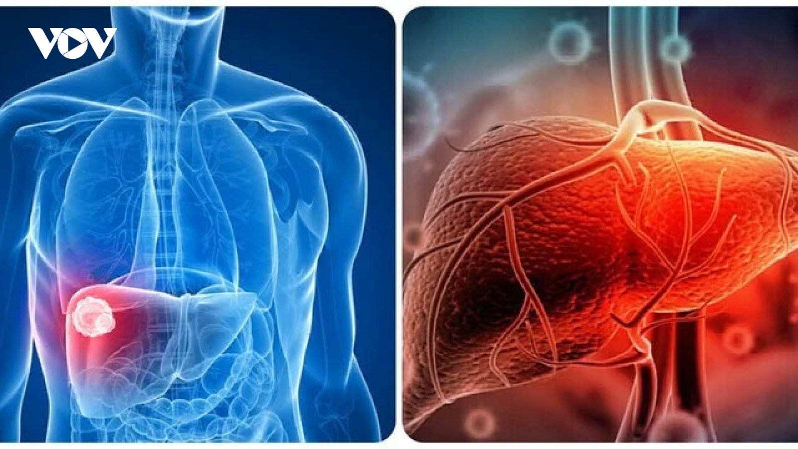 Những dấu hiệu cảnh báo ung thư gan giai đoạn đầu