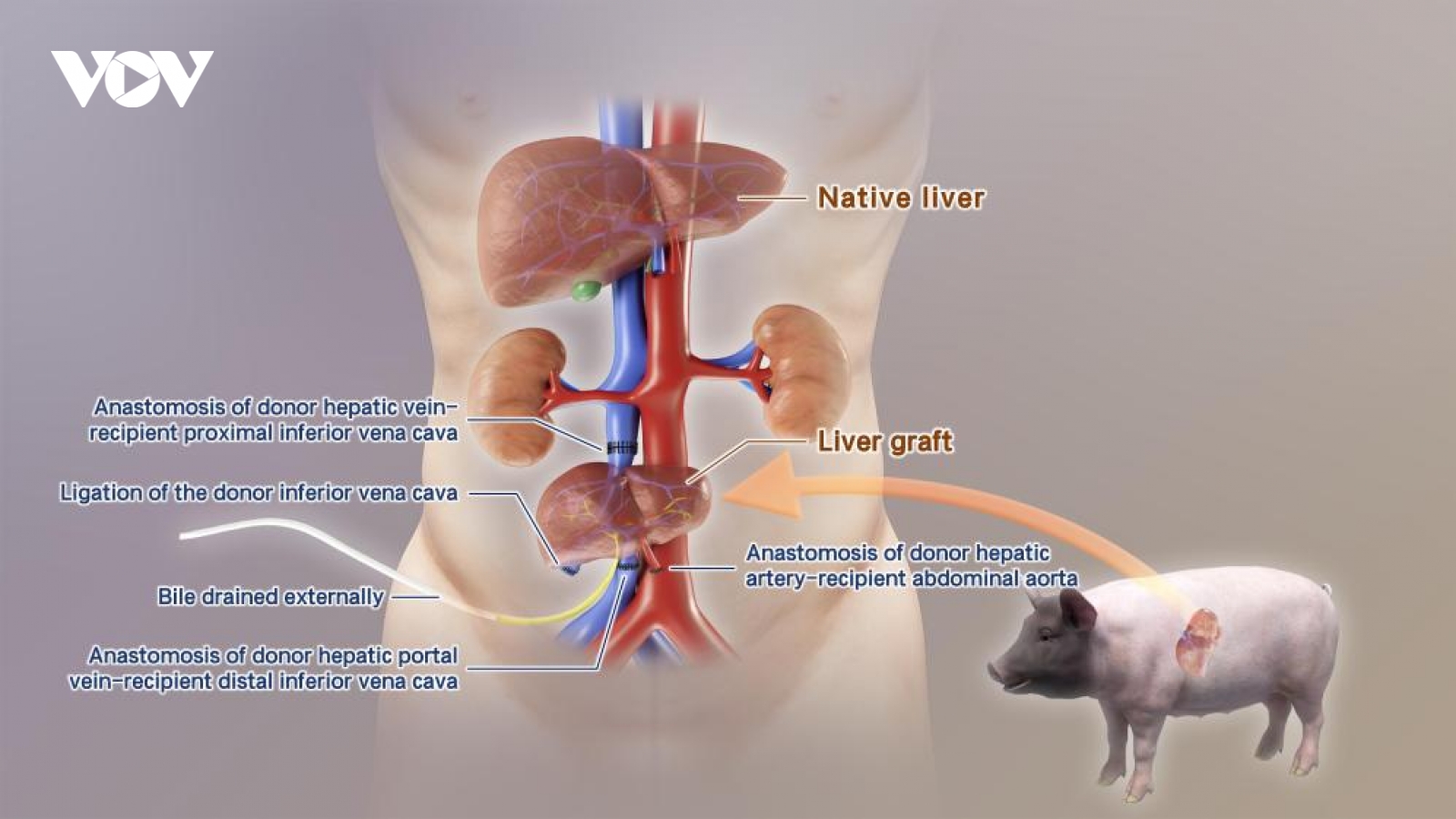Trung Quốc cấy ghép thành công gan lợn chỉnh sửa gen vào cơ thể người