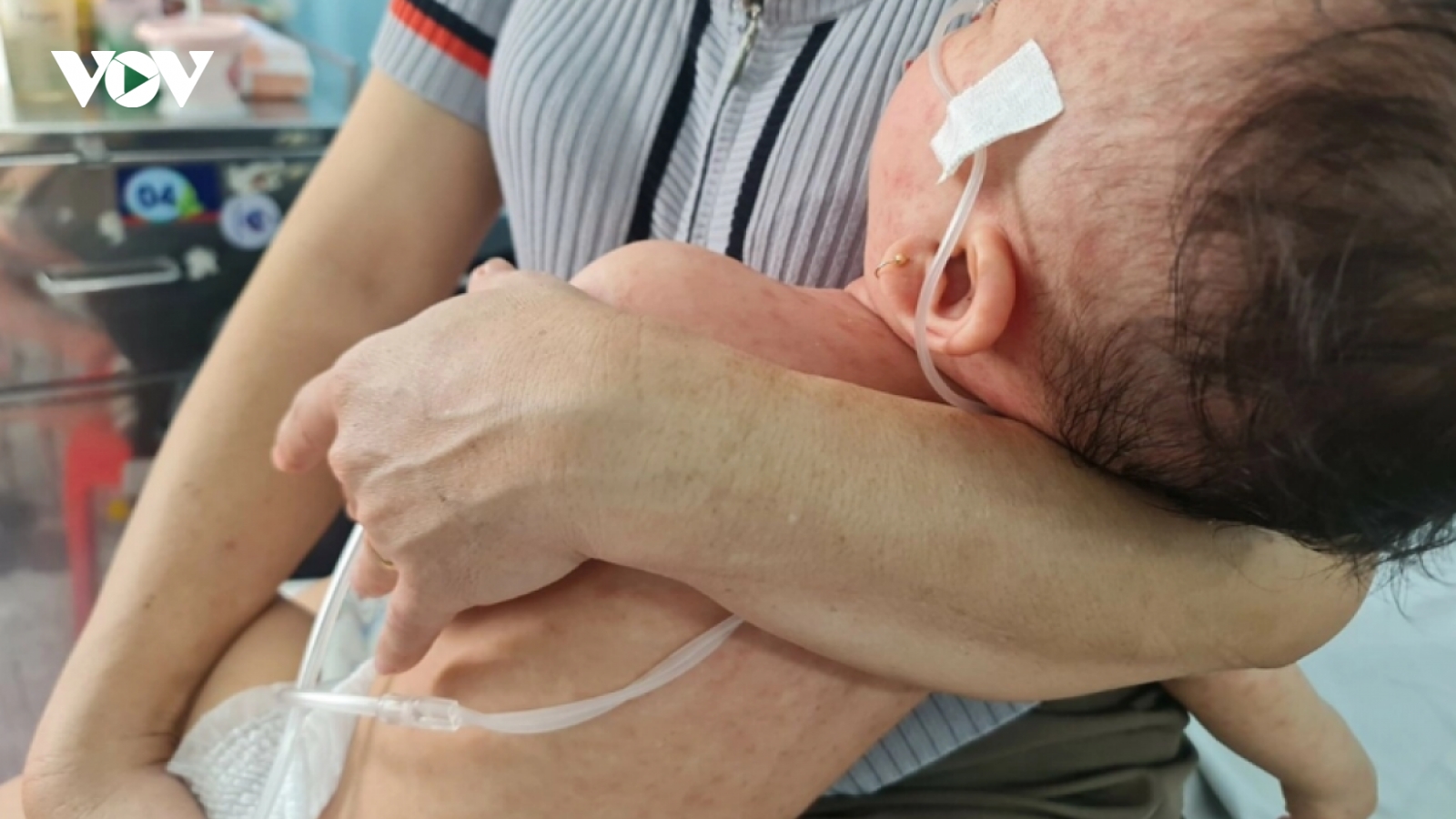 Vì sao bệnh sởi diễn tiến nhanh và nguy hiểm?