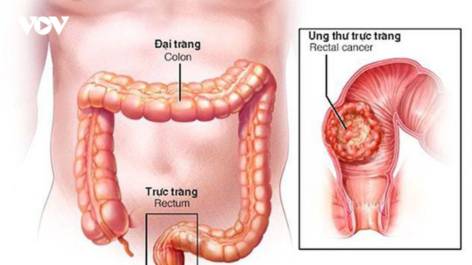 Ảnh hưởng của phẫu thuật ung thư trực tràng đến vấn đề tình dục