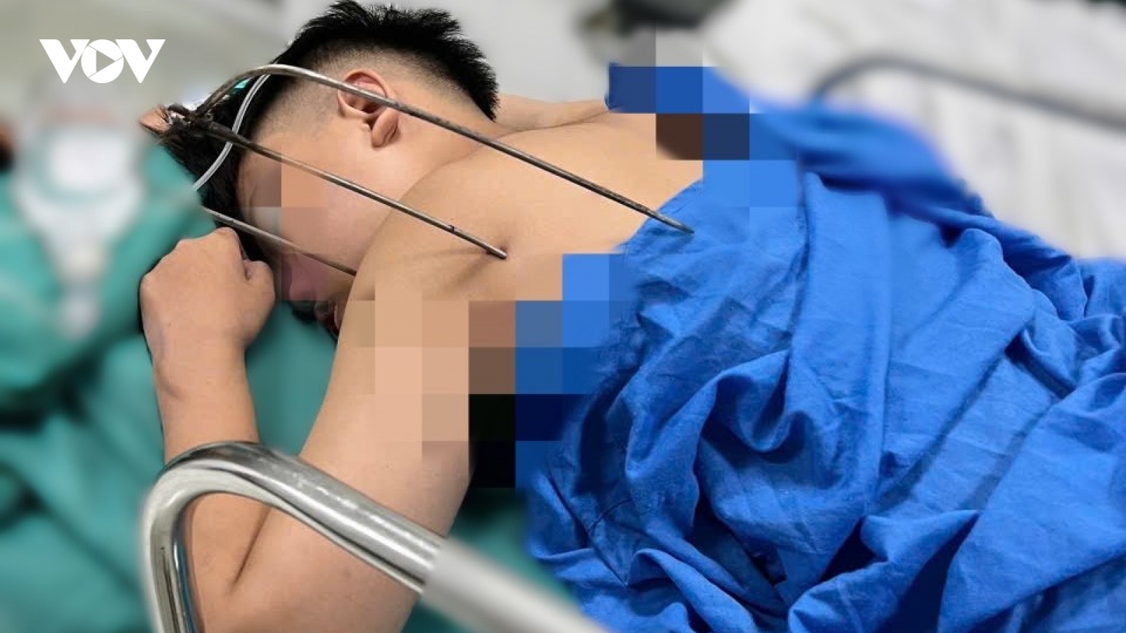 Cứu sống nam thanh niên bị dị vật kim loại tự chế xuyên thấu tim