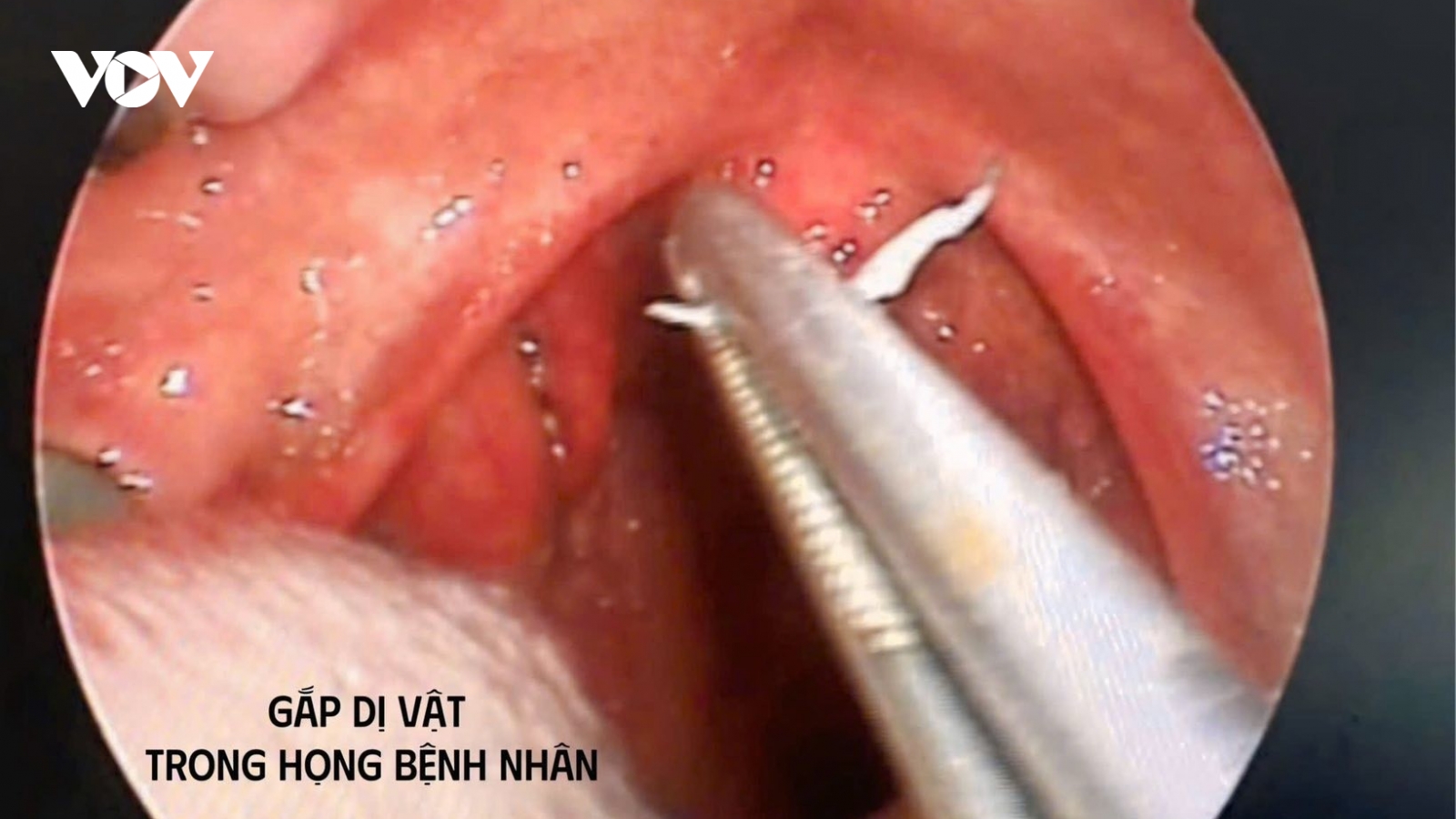 Cụ bà 79 tuổi mắc dị vật là sợi dây kim loại trong Amidan