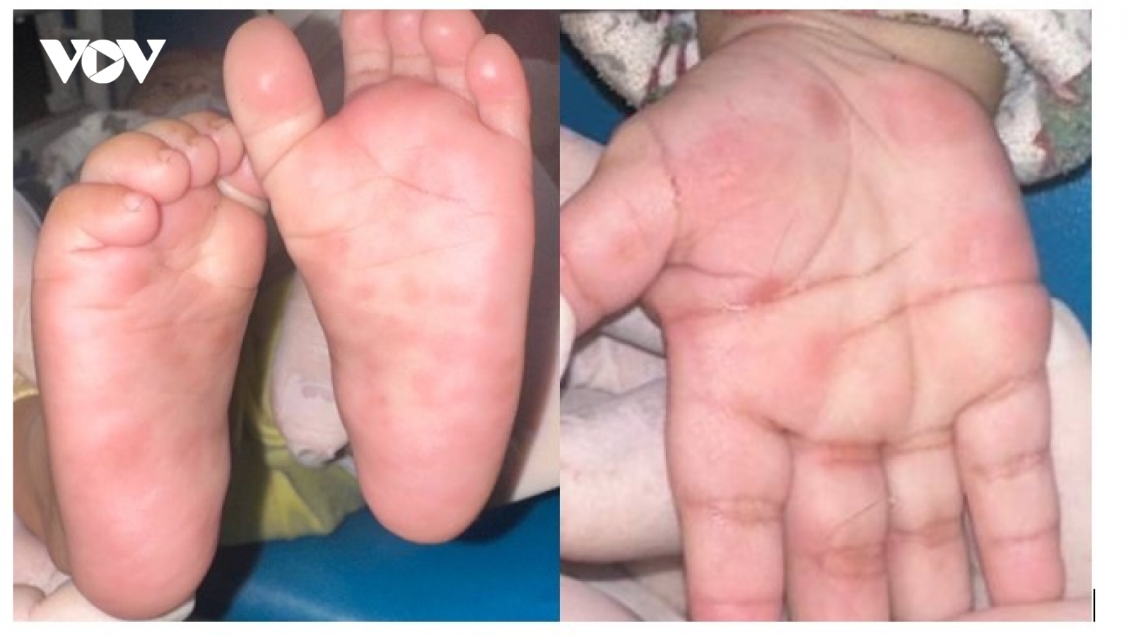 Bệnh nhi 4 tháng tuổi nhiễm giang mai do lây truyền từ mẹ