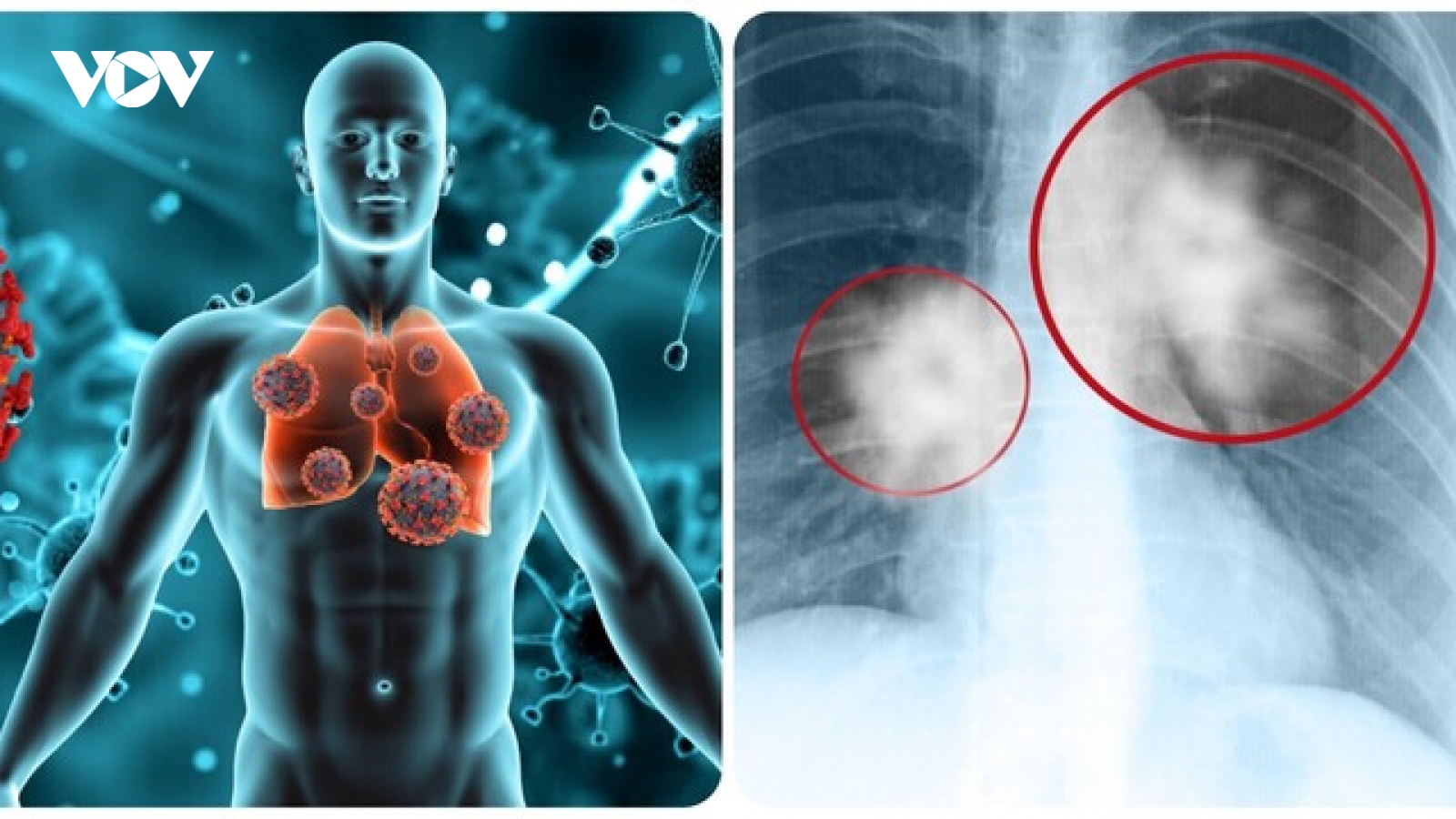 8 dấu hiệu cảnh báo ung thư phổi không nên bỏ qua