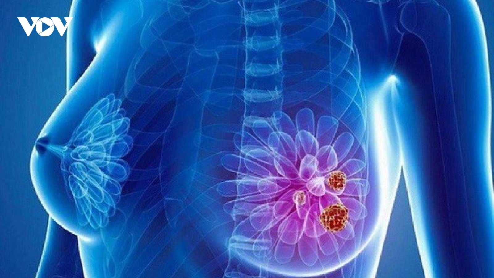 Không mang thai mà vú tiết dịch trắng có phải là dấu hiệu của ung thư vú?