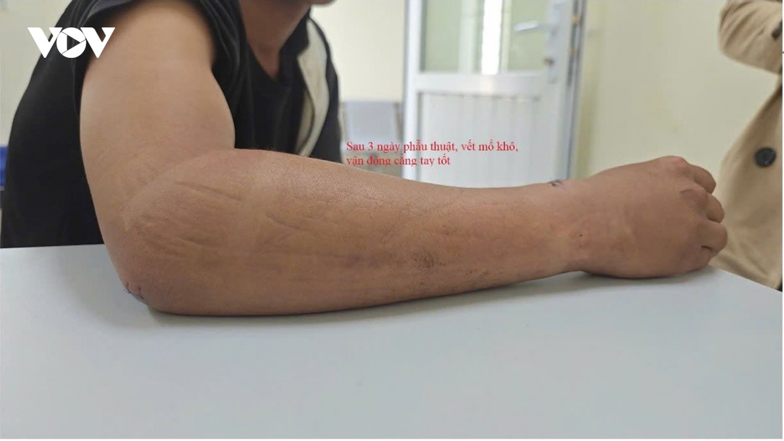 Sơn La điều trị gãy kín thân 2 xương cẳng tay bằng kỹ thuật đóng đinh Metaizeau