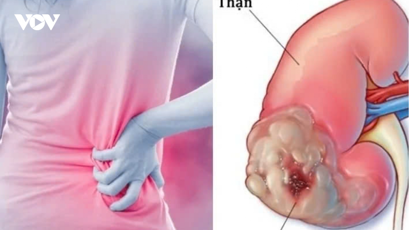 Dấu hiệu âm thầm của ung thư thận nhiều người không để ý